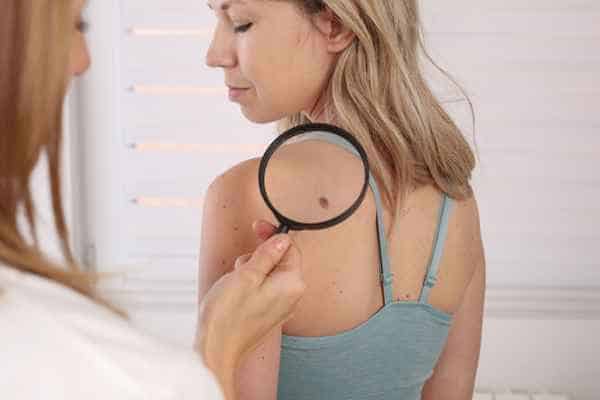 What Are Traditional Skin Lesion Removal Methods Waltham Forest?