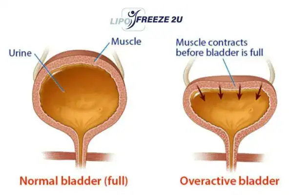 diagram of overactive bladder treatment Waltham Forest
