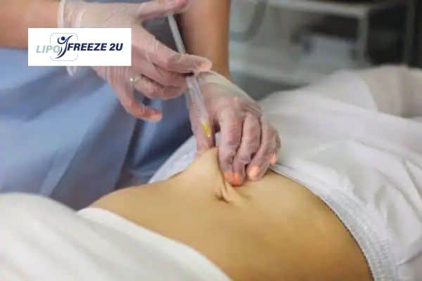 How Does Aqualyx Fat Dissolving Injection Work to Break Down Fat Waltham Forest?