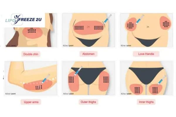 Benefits of Choosing Aqualyx for Fat Reduction Waltham Forest