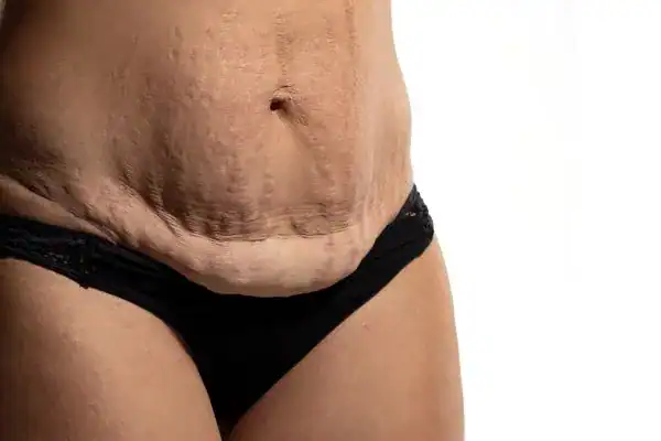 loose skin after weight loss injections Waltham Forest