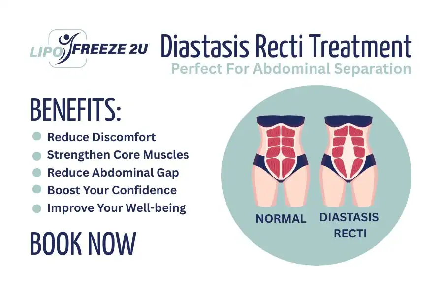 How Long Will It Take to See Improvements in Diastasis Recti Waltham Forest