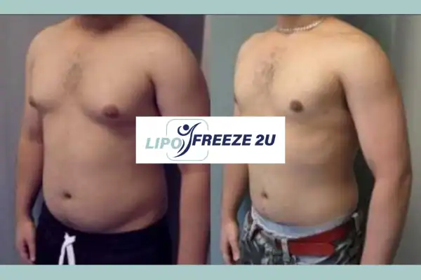 How Long Does It Take to See Results Waltham Forest?