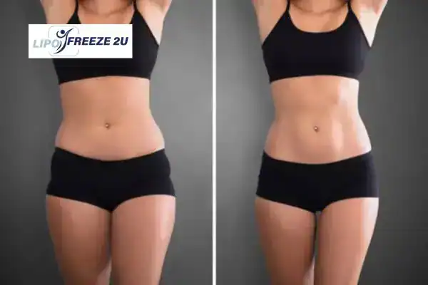How Can LIPO FREEZE 2U Support Your Post-Pregnancy Body Recovery Waltham Forest?