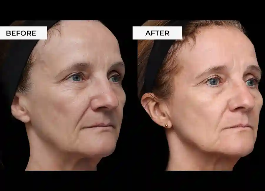 How Many RF Microneedling Sessions Will You Need to See a Difference Waltham Forest?