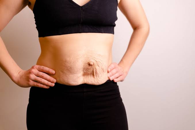 Is Surgery Really the Only Way to Repair Diastasis Recti Waltham Forest?