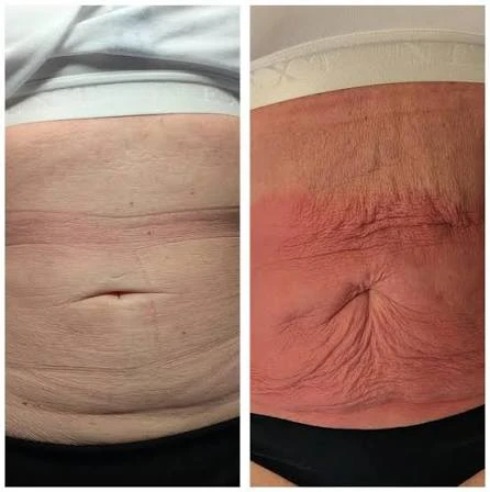 How Does RF Microneedling Improve Crepey, Thin and Uneven Skin Texture Waltham Forest?
