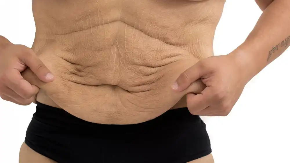 RF Microneedling for Loose Skin: How Can It Help Tighten and Reshape the Skin Waltham Forest?
